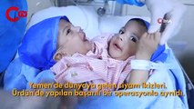 Ürdün’de başarılı operasyonla ayrılan Yemenli siyam ikizleri evlerine döndü