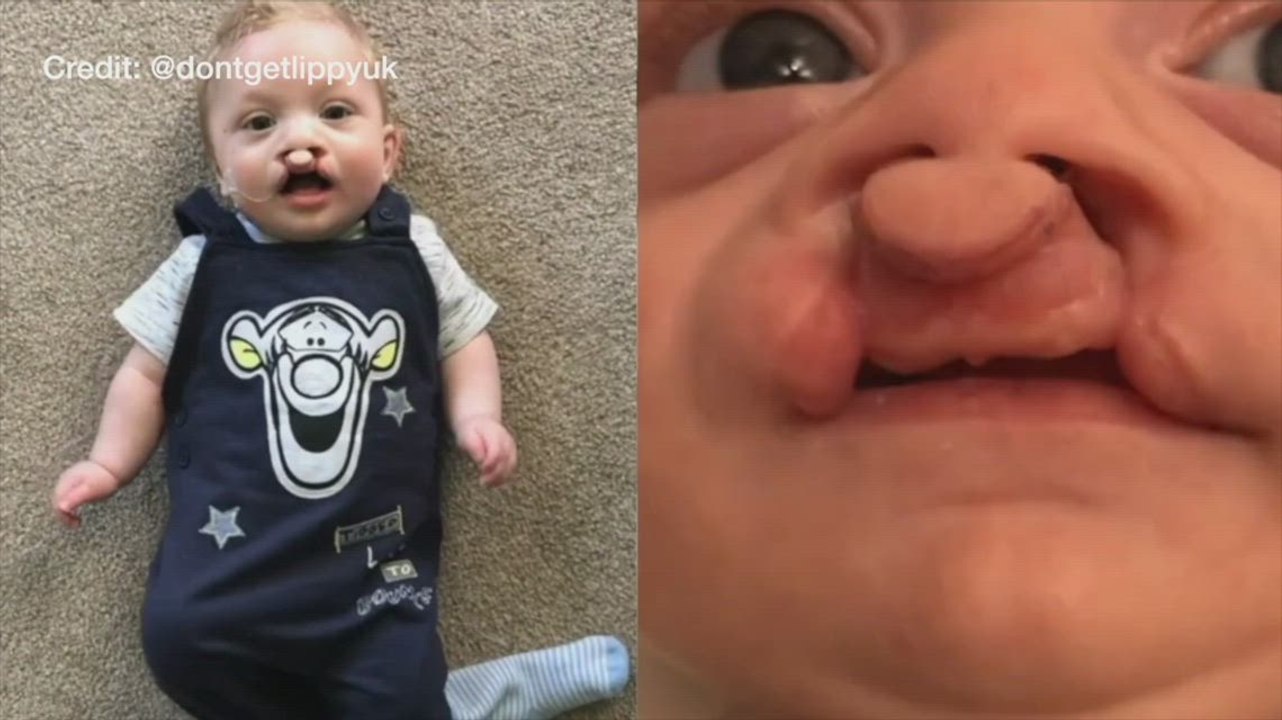 Jen Cross - Cleft Lip Interview