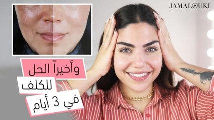 خلطات طبيعية تساعد على علاج الكلف خلال 3 أيام