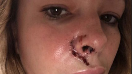 GALA VIDEO - Cindy de Koh Lanta mordue par un chien, la future maman dévoile ses cicatrices au visage