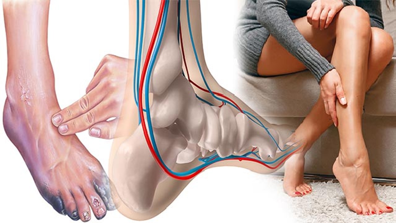 धमनी रोग क्या है | धमनी रोग के लक्षण | Peripheral Artery Disease In Legs Hindi | Boldsky