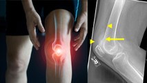 घुटने में पानी भरने का कारण, Knee Effusion का Symptoms नजरअंदाज करना खतरनाक | Boldsky