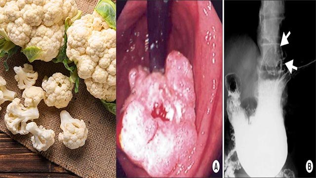 फूलगोभी खाने से गैस क्यों होती है | Cauliflower Khane Se Gas Kyu Hoti Hai | Boldsky