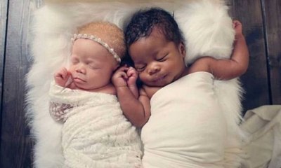 Ces jumeaux uniques ont bien grandi et vont faire fondre votre coeur