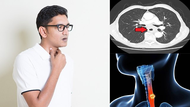Food Pipe Cancer कैसे होता है, Symptoms और Reasons ना करें नजरअंदाज | Boldsky