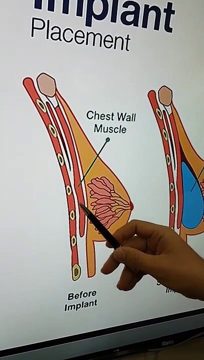 تكبير الثدي مع د امير مراد استشاري جراحة التجميل