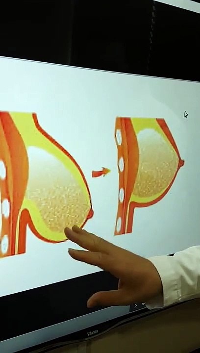 شد ورفع الثدي   دكتور امير