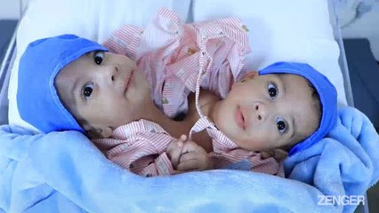 Conjoined Twins Separated In 25-Hour Op Fly Back To War-Torn Yemen.mp4