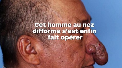Cet homme au nez difforme s'est enfin fait opérer