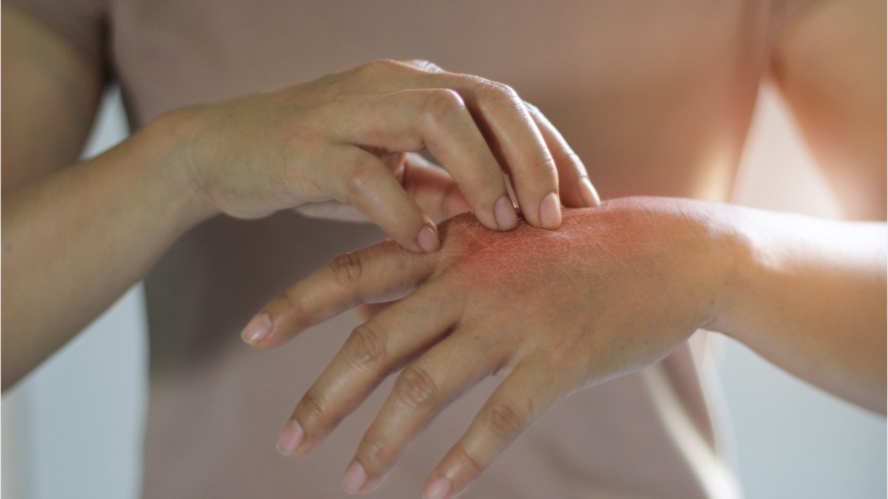 Intertrigo : quels sont les causes et les traitements de cette affection de  la peau ? : Femme Actuelle Le MAG