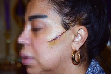 ESKİ SEVGİLİSİNİN YÜZÜNÜ USTURA İLE KESEN ŞÜPHELİ, TUTUKLANDI