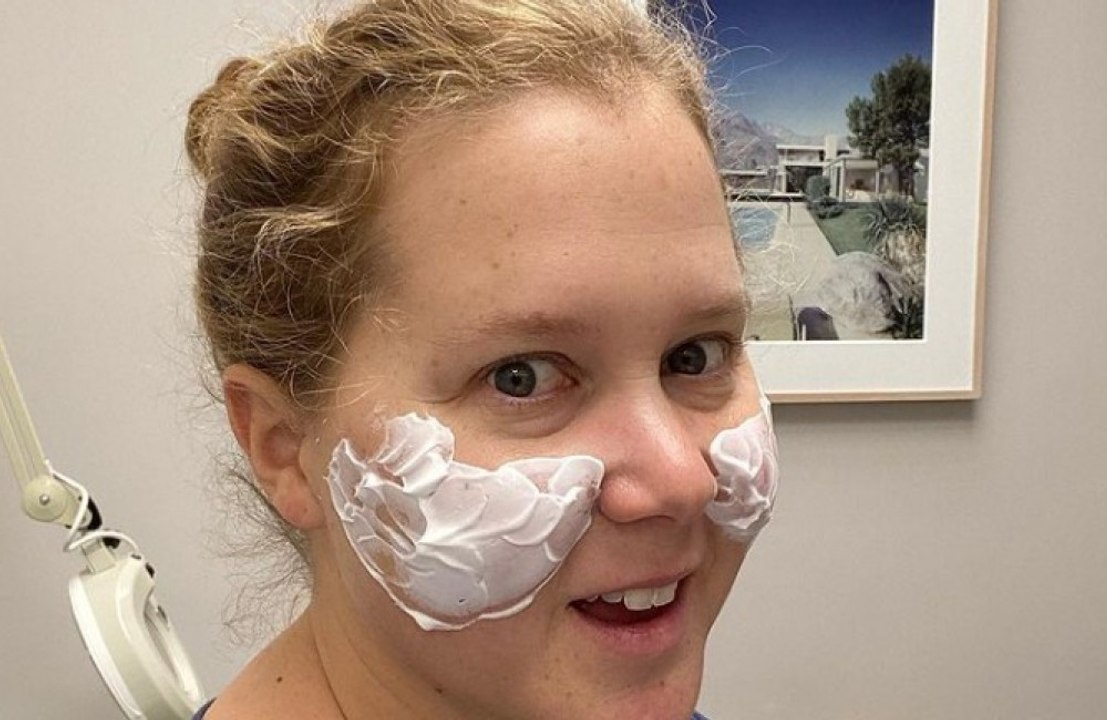 'I looked like Maleficent': Amy Schumer gets cheek fillers dissolved