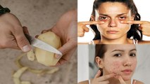 कच्चा आलू चेहरे पर लगाने से क्या होता है, Dark Circles से लेकर Pimples तक गायब | Boldsky