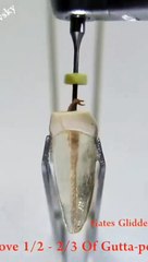 Dental , post and core