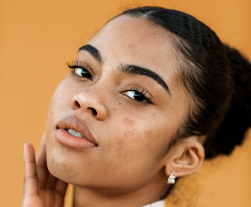 The Best Skincare Routine for Acne, According to Dermatologists