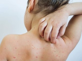 كل ما تريد معرفته عن مرض الحصبة وعلاجها