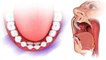 दांत के पीछे नए दांत निकलना Oral Tumour से लेकर Fabry Disease तक का Symptom | Boldsky