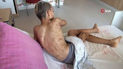 10 köpeğin saldırısına uğrayan 12 yaşındaki Enes, 9 cerrahi operasyon geçirdi, 6-7 tane daha geçirmesi planlanıyor