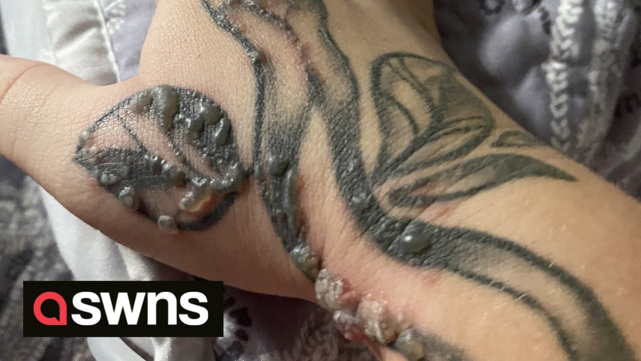 UK mum's tattoo erupts in painful warts due to rare reaction to pregnancy - video Dailymotion