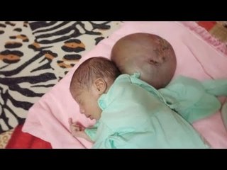 رحمة تعاني من عيب خلقي خطير.. ووالدتها: قلبي بيتقطع