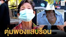 ยายสุดทรมาน เป็นตุ่มพองแสบร้อนหลังรับวัคซีน  | ข่าวเที่ยงอมรินทร์ | 5 ม.ค.65