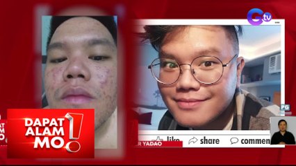 Dapat Alam Mo!: Male acne, paano masosolusyonan?