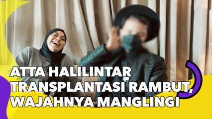 Atta Halilintar Jalani Transplantasi Rambut, Wajahnya Langsung Manglingi