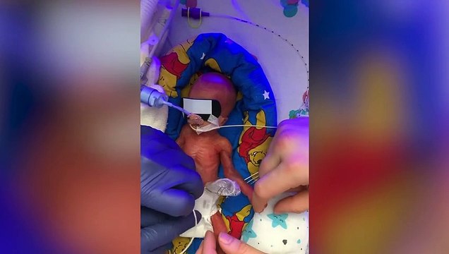 The UK's smallest premature baby