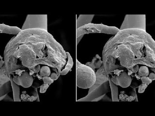 فقدت بصرها.. طبيب أنف وأذن يكشف تفاصيل اكتشافه لمريضة بالفطر الأسود بالفيوم