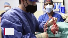 US surgeons successfully implant pig heart in human