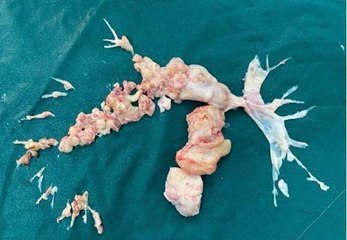 KOVİD'E BAĞLI PIHTI SANILDI, AMELİYATTA ORTAYA ÇIKAN GERÇEK DOKTORLARI BİLE ŞAŞIRTTI