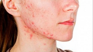 bd-causas-y-tratamientos-del-acne-tardio-140122
