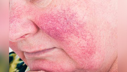चेहरे पर लाल निशान से हो सकती है गंभीर परेशानी । ऐसे पहचानें लक्षण । Boldsky