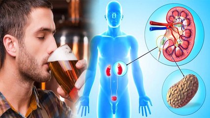 बियर पीने से पथरी निकल जाती है क्या, जानें दावे की सच्चाई | Boldsky