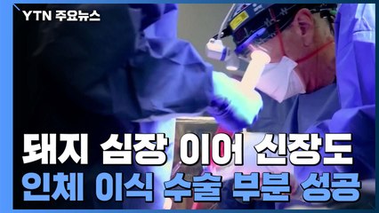돼지 심장 이어 신장도 인체에 이식...장기 부족 해결에 청신호 / YTN