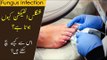 Fungal Infection Treatment | Fungal Infection ka Ilaaj | Tips by Dr. Abdullah Yahya