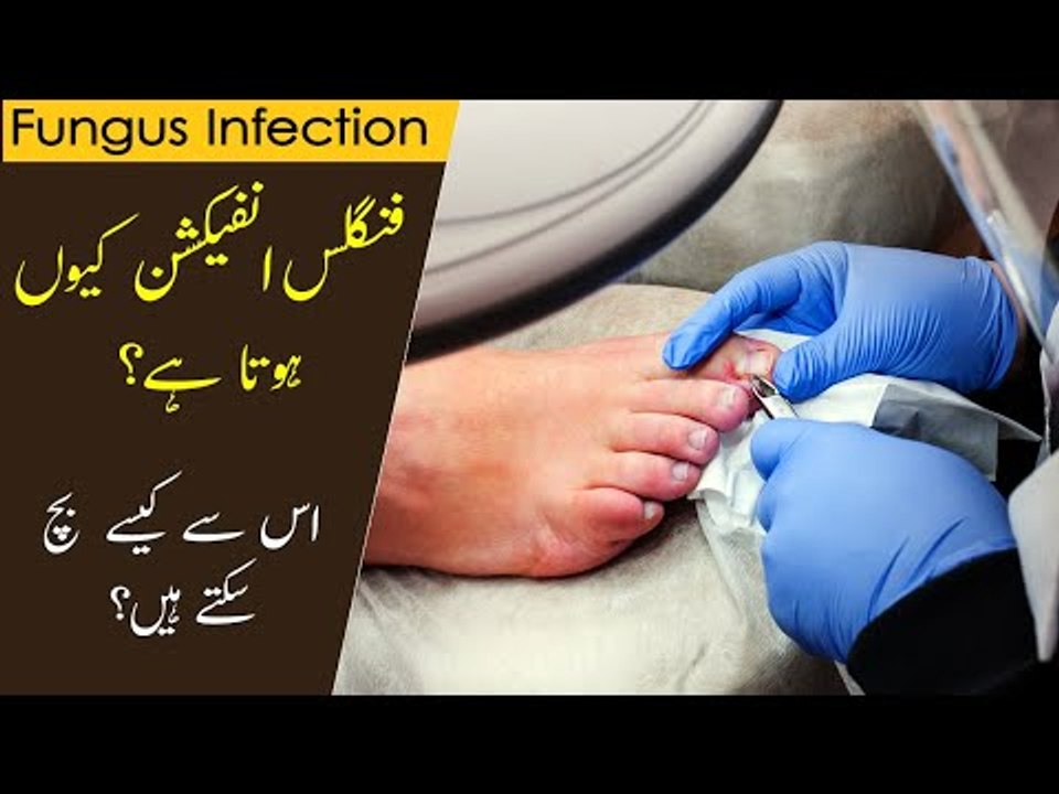 Fungal Infection Treatment | Fungal Infection ka Ilaaj | Tips by Dr. Abdullah Yahya