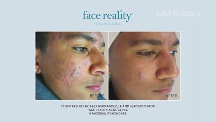Acne Awareness