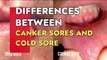 Canker sore and Cold Sores