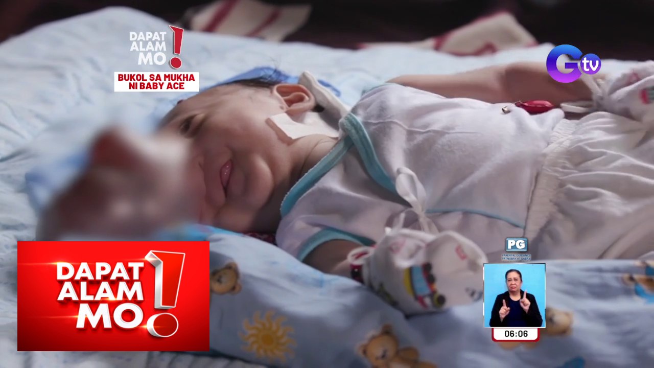Ipinanganak na sanggol na may malaking bukol sa mukha, ano’ng kondisyon? | Dapat Alam Mo!