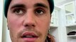 Justin Bieber says he has Ramsay Hunt Syndrome