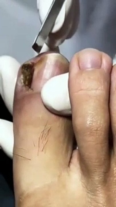 Removal Ingrown toe nail