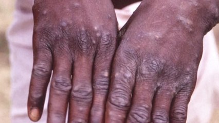 원숭이두창 치료제 다음 달 도입...고위험 접촉자 3주 격리 검토 / YTN