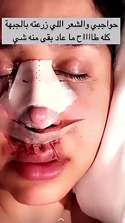 هند القحطاني تظهر بشكل صادم بعد إجرائها عملية تجميل