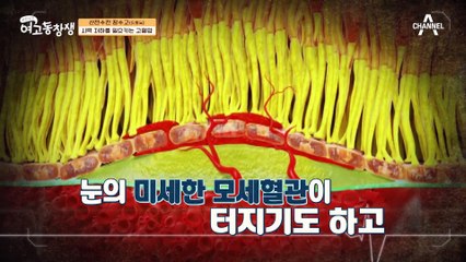 고혈압이 시력 저하를 유발한다? 망막 속 미세 혈관을 망가뜨리는 고혈압