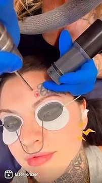 Après une erreur de tatouage, elle se fait enlever les marques au laser