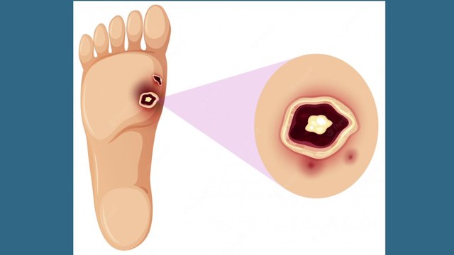 bd-riesgos-de-ulceras-en-pie-diabetico-130622