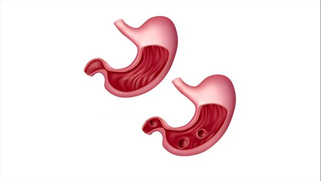 bd-cuidados-que-deben-tener-las-personas-con-ulceras-gastricas-240122