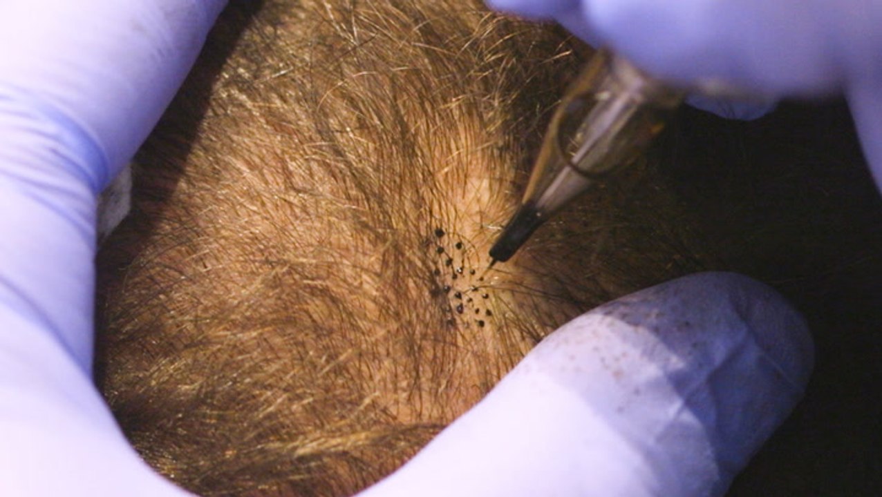 Scalp micropigmentation tattoos fill in bald spots