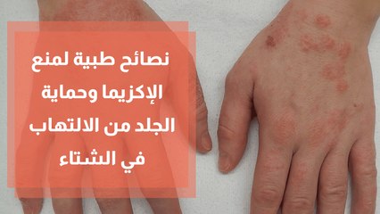 نصائح طبية لمنع الإكزيما وحماية الجلد من الالتهاب في الشتاء